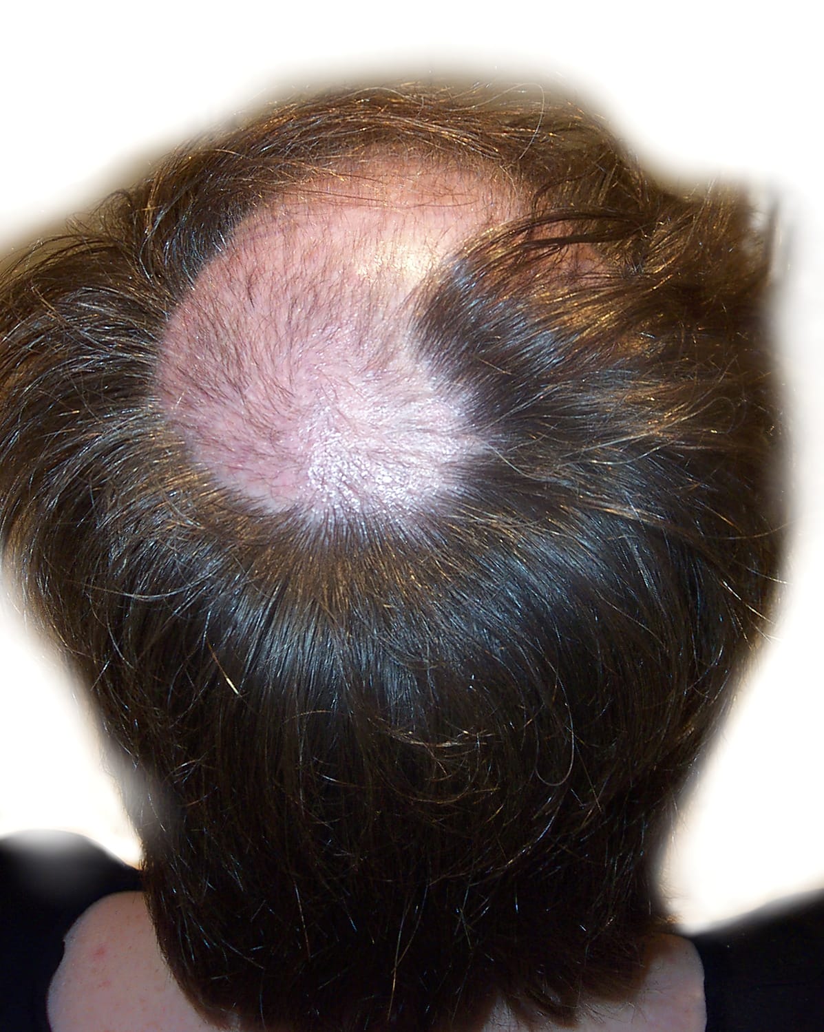 Before Picture - Trichotillomania & Full Recovery